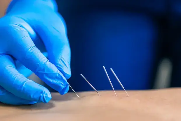 acupuncture